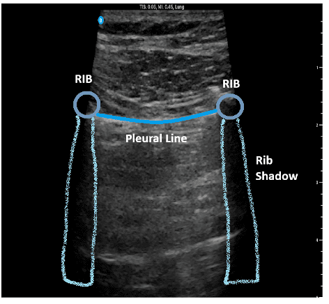 Ultrasound view of pleural lines in normal lung