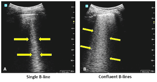 Ultrasound image of lung with B lines
