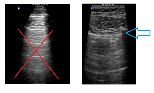 Ultrasound view demonstrating depth optimization