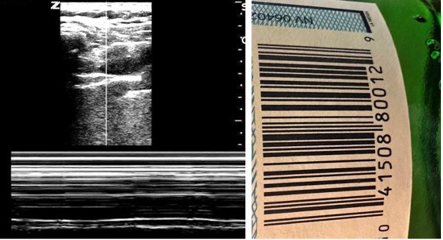 Ultrasound image of pneumothorax