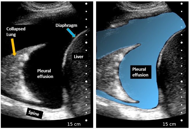 Ultrasound image of pleural effusion