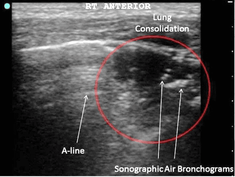 Ultrasound image of pneumonia