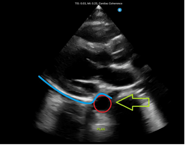 Ultrasound view of fluid above the aorta