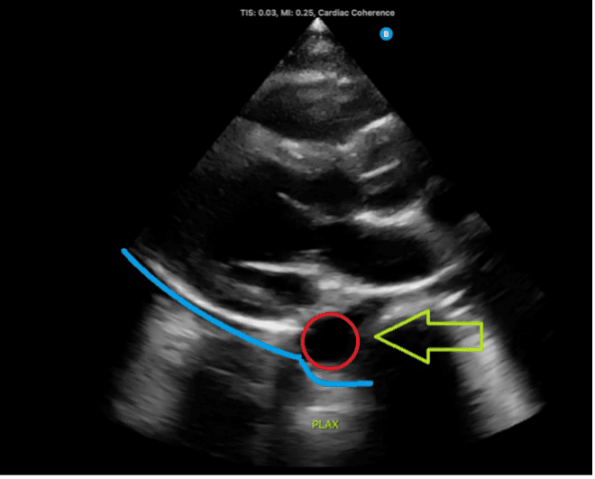 Ultrasound view of fluid below the aorta