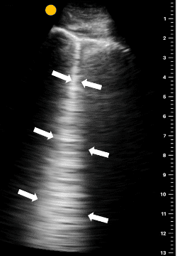 Lung ultrasound image of a single B-line