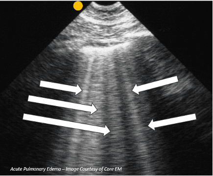 Lung ultrasound image with multiple B-lines