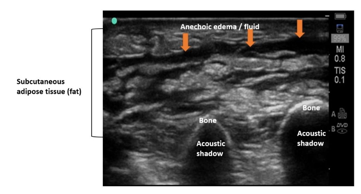 Ultrasound image of cellulitis with hyperechoic fat lobules separated by hypoechoic fluid