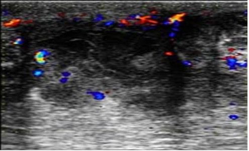 Ultrasound view of an abscess with ill defined heterogeneous lesion