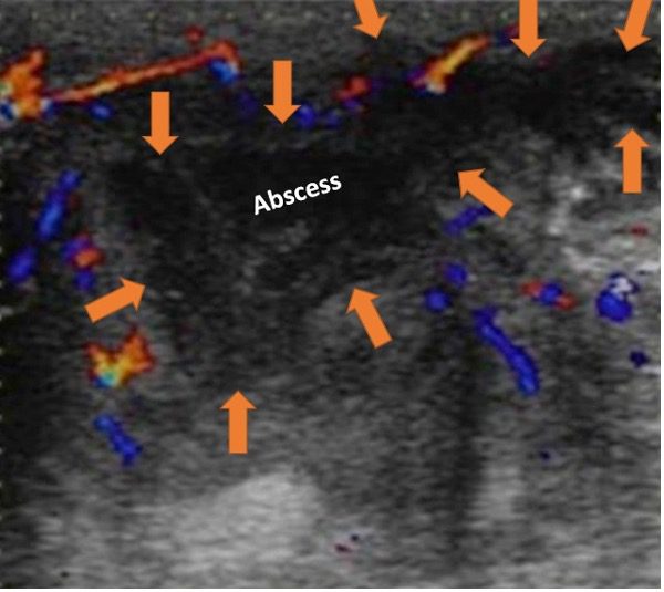 Utrasound view of an abscess