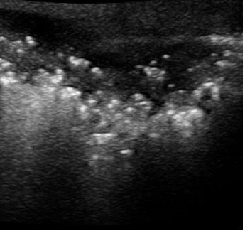 Ultrasound view of necrotizing fascitis