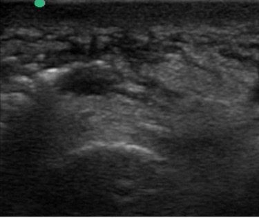 Ultrasound view of gas gangrene in early stage