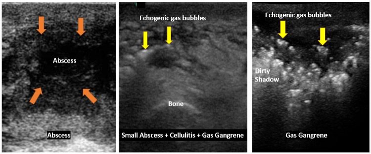 Panel ultrasound view of multiple soft tissue issues