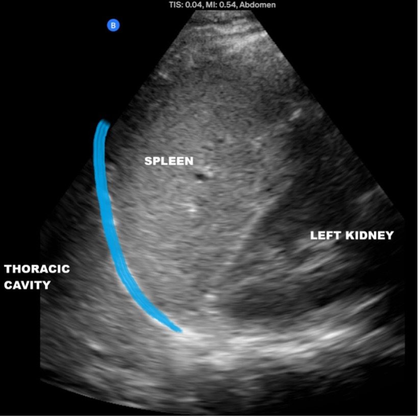 Ultrasound view of spleen-diaphragm interface