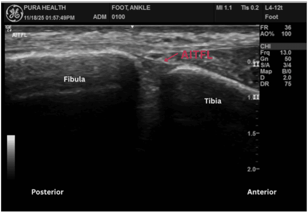 Ultrasound view of ankle