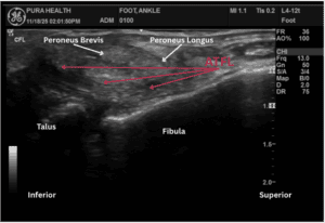 Ultrasound view of the ankle