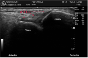 Ultrasound view of the ankle