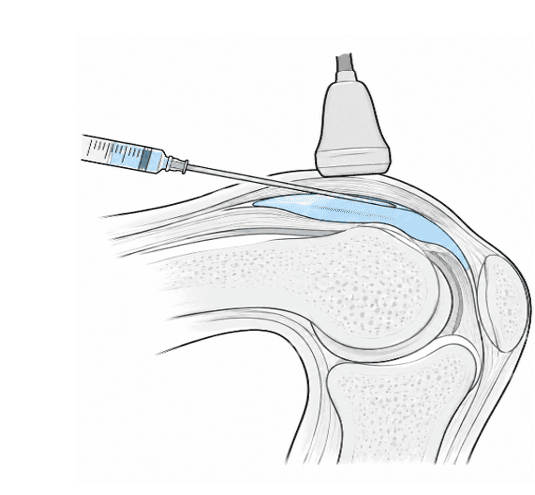 Diagrammatic representation of a knee joint injection