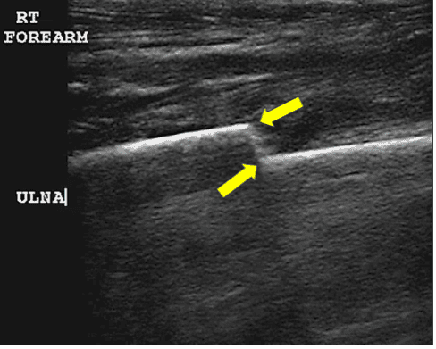 Ultrasound view of an ulna