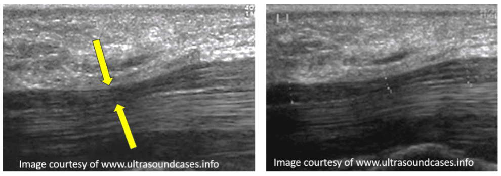 Ultrasound view of the median nerve