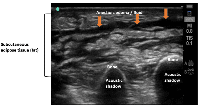 Ultrasound view of cellulitis tissue architecture