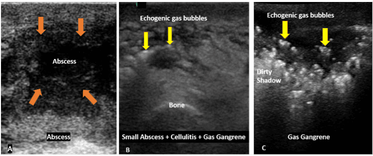 Ultrasound view of soft tissue abcess
