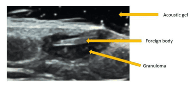 Ultrasound view of a foreign body