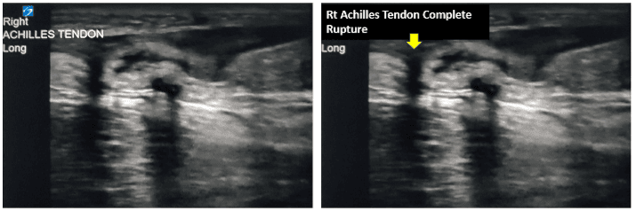 Ultrasound view of an achilles tendon rupture