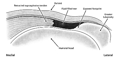 Diagrammatic view of a supraspinatus tear