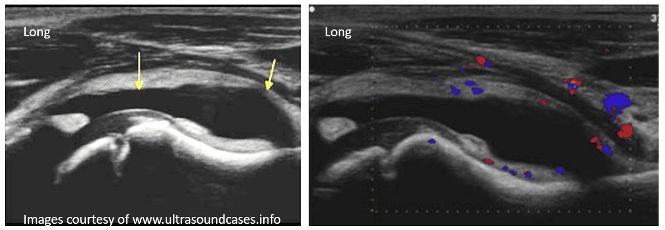 Ultrasound view of coxitis fugax