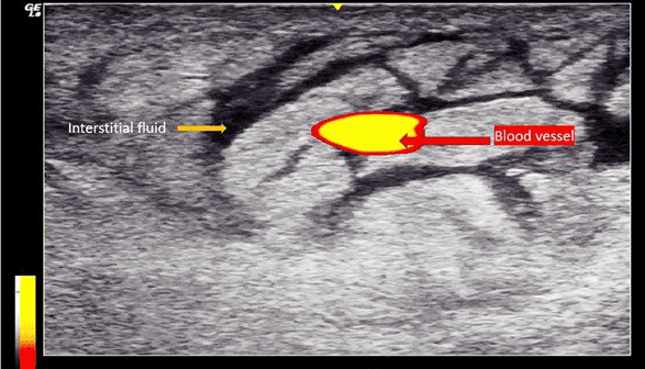 Labeled ultrasound image of a swollen left thigh