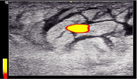 Ultrasound image of swollen left thigh