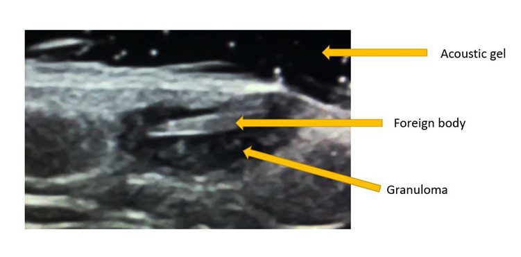 Labeled diagram of soft tissue ultrasound view