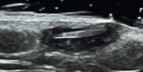 Image of soft tissue ultrasound